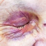 老年人眼部皺紋與傷口，展現高齡健康護理與醫療需求。.